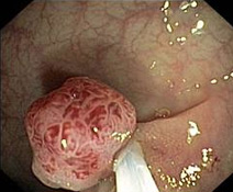 Polypabtragung